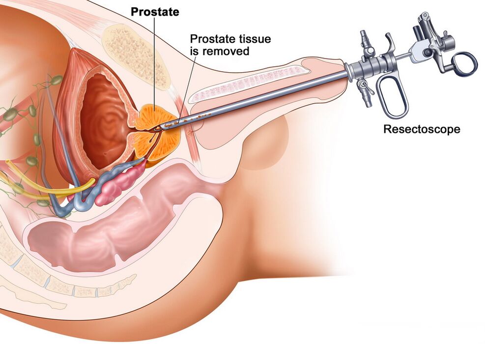 Verzameling van prostaatweefsel voor nauwkeurige diagnose van prostatitis