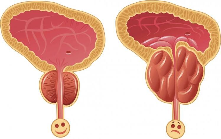 Gezonde prostaat en prostatitis